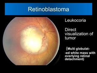Retinoblastoma 
Leukocoria 
Direct 
visualization of 
tumor 
(Multi globulat- 
-ed white mass with 
overlying retinal 
detachment) 
 