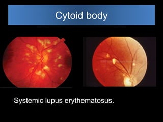 Cytoid body 
Systemic lupus erythematosus. 
 
