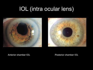 IOL (intra ocular lens) 
Anterior chamber IOL Posterior chamber IOL 
 