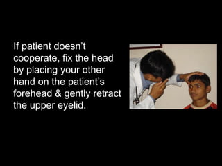 If patient doesn’t 
cooperate, fix the head 
by placing your other 
hand on the patient’s 
forehead & gently retract 
the upper eyelid. 
 