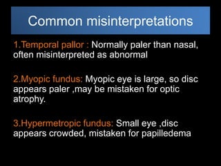 Common misinterpretations 
1.Temporal pallor : Normally paler than nasal, 
often misinterpreted as abnormal 
2.Myopic fundus: Myopic eye is large, so disc 
appears paler ,may be mistaken for optic 
atrophy. 
3.Hypermetropic fundus: Small eye ,disc 
appears crowded, mistaken for papilledema 
 