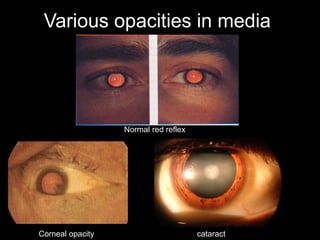 Various opacities in media 
Normal red reflex 
Corneal opacity cataract 
 