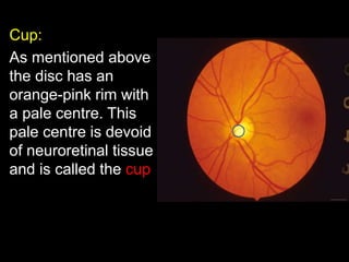 Cup: 
As mentioned above 
the disc has an 
orange-pink rim with 
a pale centre. This 
pale centre is devoid 
of neuroretinal tissue 
and is called the cup 
 