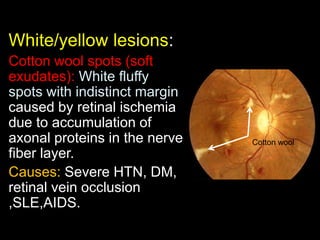 White/yellow lesions: 
Cotton wool spots (soft 
exudates): White fluffy 
spots with indistinct margin 
caused by retinal ischemia 
due to accumulation of 
axonal proteins in the nerve 
fiber layer. 
Causes: Severe HTN, DM, 
retinal vein occlusion 
,SLE,AIDS. 
Cotton wool 
 