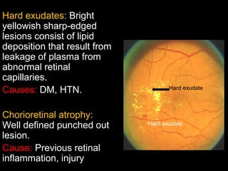 Hard exudates: Bright 
yellowish sharp-edged 
lesions consist of lipid 
deposition that result from 
leakage of plasma from 
abnormal retinal 
capillaries. 
Causes: DM, HTN. 
Chorioretinal atrophy: 
Well defined punched out 
lesion. 
Cause: Previous retinal 
inflammation, injury 
Hard exudate 
Hard exudate 
 