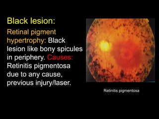 Black lesion: 
Retinal pigment 
hypertrophy: Black 
lesion like bony spicules 
in periphery. Causes: 
Retinitis pigmentosa 
due to any cause, 
previous injury/laser. 
Retinitis pigmentosa 
 