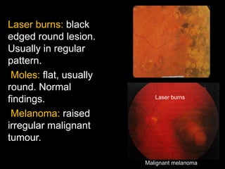 Laser burns: black 
edged round lesion. 
Usually in regular 
pattern. 
Moles: flat, usually 
round. Normal 
findings. 
Melanoma: raised 
irregular malignant 
tumour. 
Laser burns 
Malignant melanoma 
 