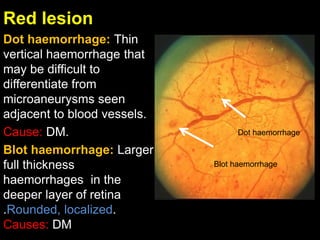 Red lesion 
Dot haemorrhage: Thin 
vertical haemorrhage that 
may be difficult to 
differentiate from 
microaneurysms seen 
adjacent to blood vessels. 
Cause: DM. 
Blot haemorrhage: Larger 
full thickness 
haemorrhages in the 
deeper layer of retina 
.Rounded, localized. 
Causes: DM 
Dot haemorrhage 
Blot haemorrhage 
 