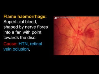Flame haemorrhage: 
Superficial bleed, 
shaped by nerve fibres 
into a fan with point 
towards the disc. 
Cause: HTN, retinal 
vein oclusion. 
 