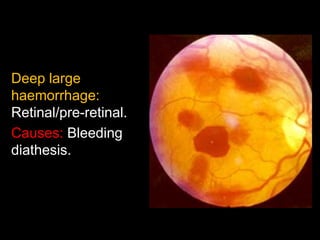 Deep large 
haemorrhage: 
Retinal/pre-retinal. 
Causes: Bleeding 
diathesis. 
 
