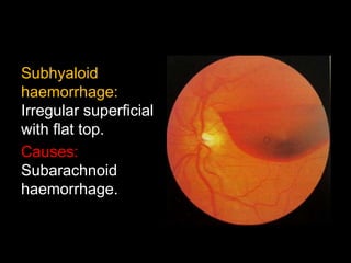 Subhyaloid 
haemorrhage: 
Irregular superficial 
with flat top. 
Causes: 
Subarachnoid 
haemorrhage. 
 