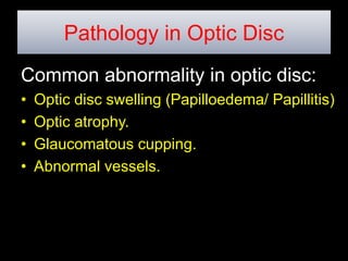 Pathology in Optic Disc 
Common abnormality in optic disc: 
• Optic disc swelling (Papilloedema/ Papillitis) 
• Optic atrophy. 
• Glaucomatous cupping. 
• Abnormal vessels. 
 
