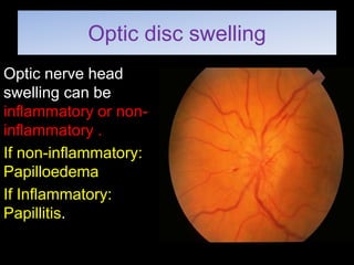 Optic disc swelling 
Optic nerve head 
swelling can be 
inflammatory or non-inflammatory 
. 
If non-inflammatory: 
Papilloedema 
If Inflammatory: 
Papillitis. 
 