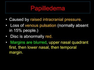 Papilledema 
• Caused by raised intracranial pressure. 
• Loss of venous pulsation (normally absent 
in 15% people.) 
• Disc is abnormally red. 
• Margins are blurred, upper nasal quadrant 
first, then lower nasal, then temporal 
margin. 
 