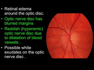 • Retinal edema 
around the optic disc. 
• Optic nerve disc has 
blurred margins 
• Reddish (hyperemic) 
optic nerve disc due 
to dilatation of blood 
vessels . 
• Possible white 
exudates on the optic 
nerve disc . 
 