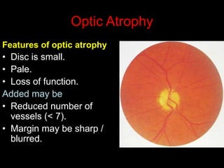 Optic Atrophy 
Features of optic atrophy 
• Disc is small. 
• Pale. 
• Loss of function. 
Added may be 
• Reduced number of 
vessels (< 7). 
• Margin may be sharp / 
blurred. 
 