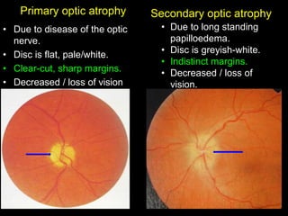 Primary optic atrophy 
• Due to disease of the optic 
nerve. 
• Disc is flat, pale/white. 
• Clear-cut, sharp margins. 
• Decreased / loss of vision 
Secondary optic atrophy 
• Due to long standing 
papilloedema. 
• Disc is greyish-white. 
• Indistinct margins. 
• Decreased / loss of 
vision. 
 