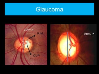 Glaucoma 
CDR= .4 
CDR= .77 
 