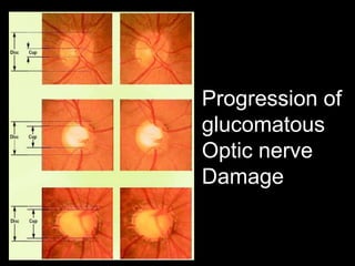 Progression of 
glucomatous 
Optic nerve 
Damage 
 