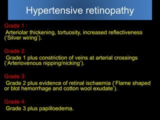 Hypertensive retinopathy 
Grade 1 : 
Arteriolar thickening, tortuosity, increased reflectiveness 
(‘Silver wiring’). 
Grade 2: 
Grade 1 plus constriction of veins at arterial crossings 
(‘Arteriovenous nipping/nicking’). 
Grade 3: 
Grade 2 plus evidence of retinal ischaemia (‘Flame shaped 
or blot hemorrhage and cotton wool exudate’). 
Grade 4: 
Grade 3 plus papilloedema. 
 