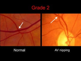 Grade 2 
Normal AV nipping 
 
