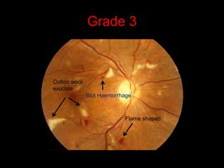 Grade 3 
Cotton wool 
exudate 
Blot Haemorrhage 
Flame shaped 
 