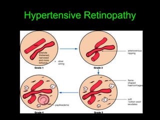 Hypertensive Retinopathy 
 