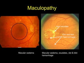 Maculopathy 
Hard exudate 
Dot and blot 
Haemorrhage 
Macular oedema Macular oedema, exudates, dot & blot 
hemorrhage 
 