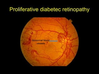 Proliferative diabetec retinopathy 
Abnormal blood 
vessels 
 