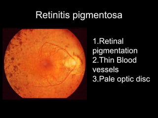 Retinitis pigmentosa 
1.Retinal 
pigmentation 
2.Thin Blood 
vessels 
3.Pale optic disc 
 
