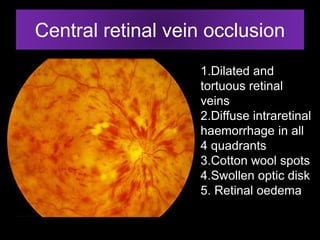 Central retinal vein occlusion 
1.Dilated and 
tortuous retinal 
veins 
2.Diffuse intraretinal 
haemorrhage in all 
4 quadrants 
3.Cotton wool spots 
4.Swollen optic disk 
5. Retinal oedema 
 