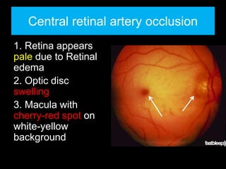 Central retinal artery occlusion 
1. Retina appears 
pale due to Retinal 
edema 
2. Optic disc 
swelling 
3. Macula with 
cherry-red spot on 
white-yellow 
background 
 