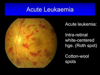 Acute Leukaemia 
Acute leukemia: 
Intra-retinal 
white-centered 
hge. (Roth spot) 
Cotton-wool 
spots 
 