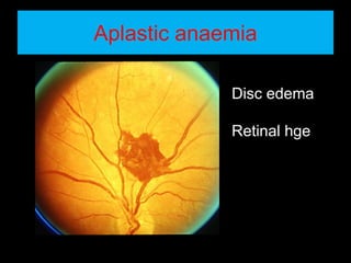 Aplastic anaemia 
Disc edema 
Retinal hge 
 