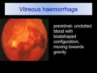 Vitreous haemorrhage 
preretinal- unclotted 
blood with 
boatshaped 
configuration, 
moving towards 
gravity 
 