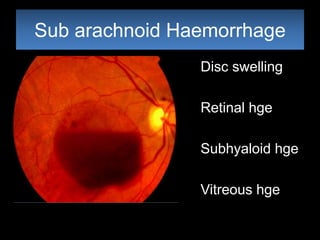Sub arachnoid Haemorrhage 
Disc swelling 
Retinal hge 
Subhyaloid hge 
Vitreous hge 
 