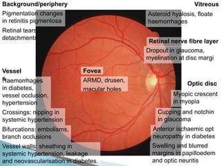 Dropout in glaucoma,
myelination at disc margi
Cupping and notchin
in glaucoma
Swelling and blurred
margins in papilloedem
and optic neuritis
Vessel walls: sheathing in
systemic hypertension, leakage
and neovascularisation in diabetes.
Crossings: nipping in
systemic hypertension
Bifurcations: embolisms,
branch occlusions
Pigmentation changes
in retinitis pigmentosa
Haemorrhages
in diabetes,
vessel occlusion,
hypertension
Myopic crescent
in myopia
ARMD, drusen,
macular holes
Retinal tears,
detachments
Anterior ischaemic opt
neuropathy in diabetes
Vessel
s
Optic disc
Fovea
Background/periphery
Retinal nerve fibre layer
Vitreous
Asteroid hyalosis, floate
haemorrhages
 