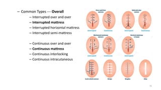 – Common Types --- Overall
– Interrupted over and over
– Interrupted mattress
– Interrupted horizontal mattress
– Interrupted semi-mattress
– Continuous over and over
– Continuous mattress
– Continuous interlocking
– Continuous intracutaneous
56
 
