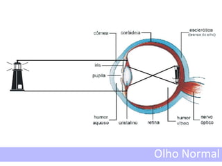 Olho Normal
 