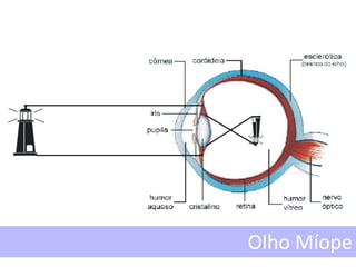 Olho Míope
 