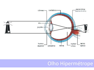 Olho Hipermétrope
 