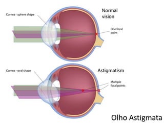 Olho Astigmata
 