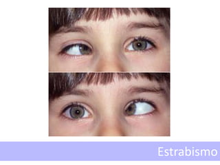 Estrabismo
 