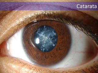 Catarata
 