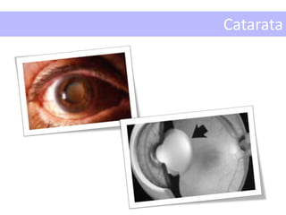 Catarata
 