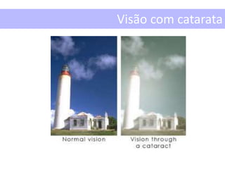 Visão com catarata
 