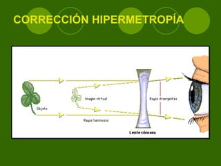 CORRECCIÓN HIPERMETROPÍA 