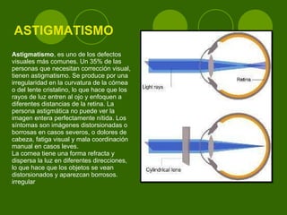 ASTIGMATISMO Astigmatismo , es uno de los defectos visuales más comunes. Un 35% de las personas que necesitan corrección visual, tienen astigmatismo. Se produce por una irregularidad en la curvatura de la córnea o del lente cristalino, lo que hace que los rayos de luz entren al ojo y enfoquen a diferentes distancias de la retina. La persona astigmática no puede ver la imagen entera perfectamente nítida. Los síntomas son imágenes distorsionadas o borrosas en casos severos, o dolores de cabeza, fatiga visual y mala coordinación manual en casos leves. La cornea tiene una forma  refracta y dispersa la luz en diferentes direcciones, lo que hace que los objetos se vean distorsionados y aparezcan borrosos.  irregular  
