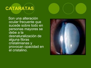 CATARATAS Son una alteración ocular frecuente que sucede sobre todo en personas mayores se debe a la desnaturalización de alguna fibras cristalinianas y provocan opacidad en el cristalino. 