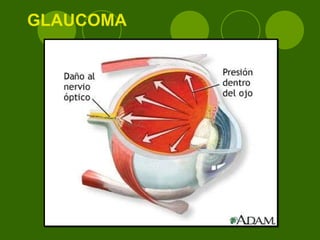 GLAUCOMA 